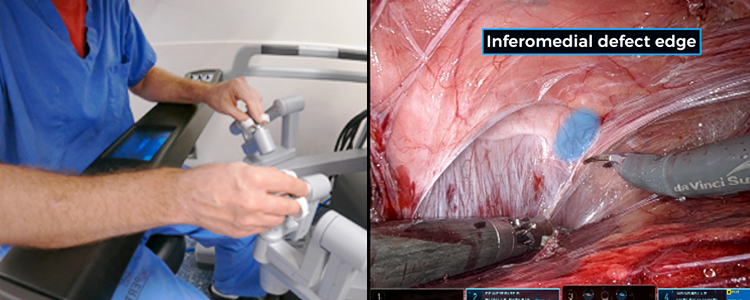 Robotic-Assisted Repair of a Left Lower Quadrant Spigelian-Type